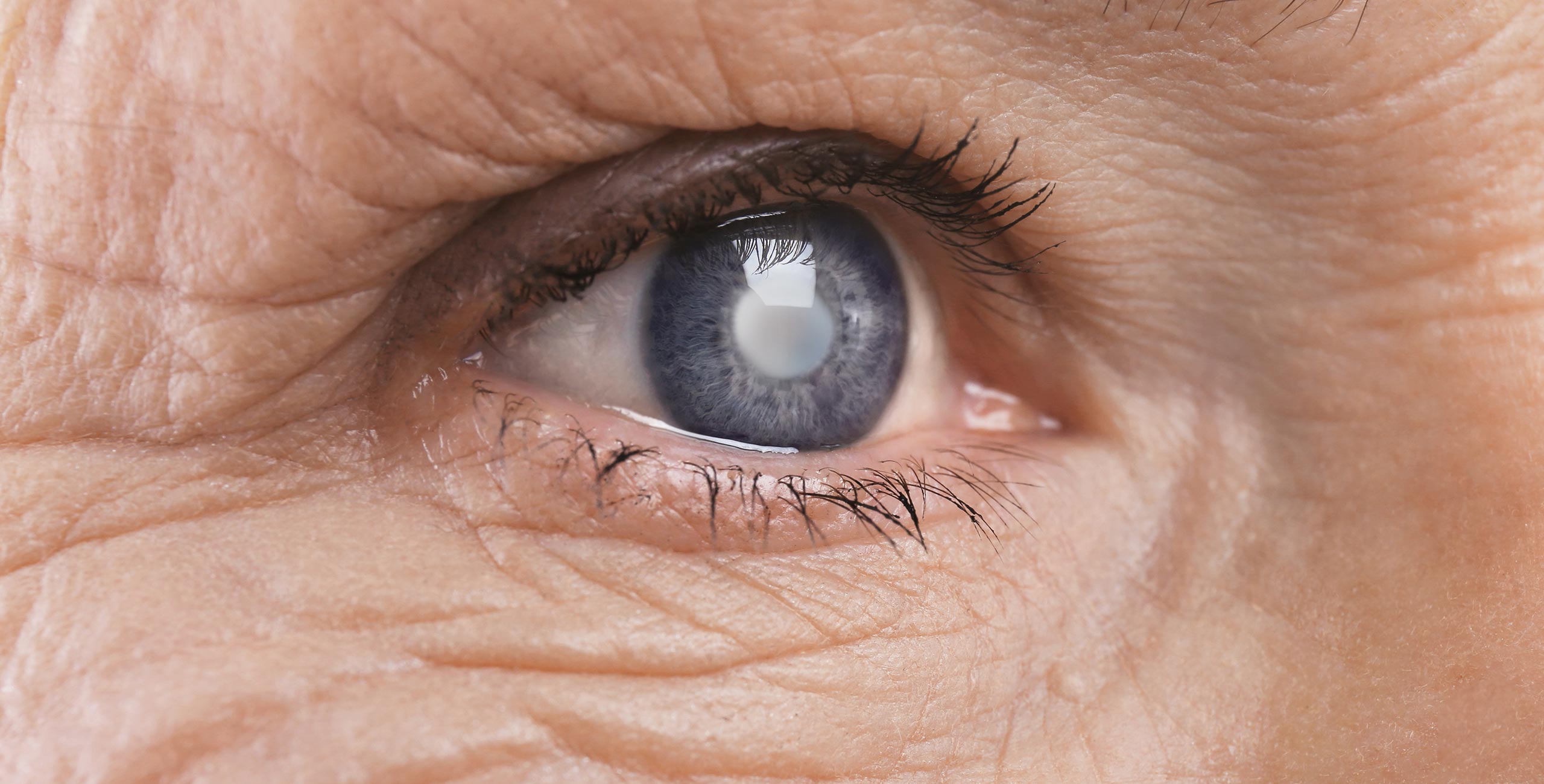 La maladie de la cataracte - Centre ophtalmologique COSS Brétigny-sur-Orge - Essoune